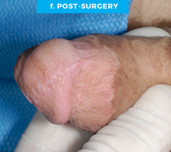 PENOSCROTAL WEBBING Patient 5 After 3
