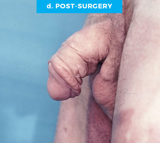 MALE GENITAL RECONSTRUCTION Patient 7 After 3