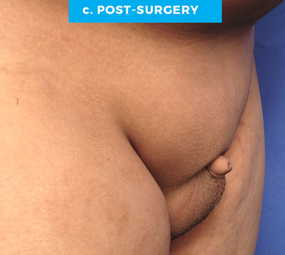 BURIED/HIDDEN PENIS CORRECTIVE SURGERY Patient 11 Before 2