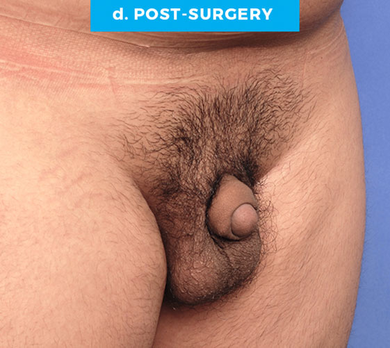 BURIED/HIDDEN PENIS CORRECTIVE SURGERY Patient 11 After 2