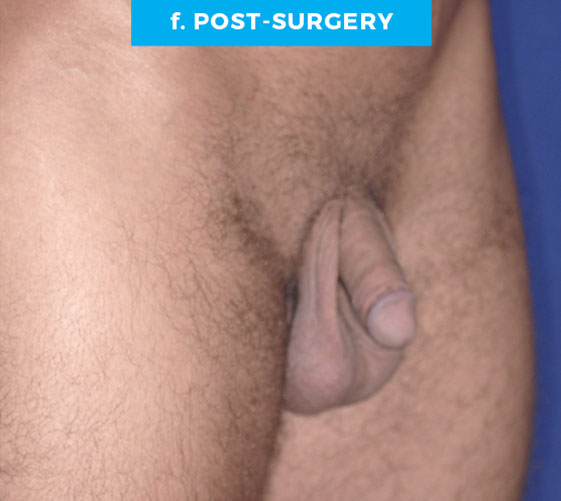 BURIED/HIDDEN PENIS CORRECTIVE SURGERY Patient 6 After 3