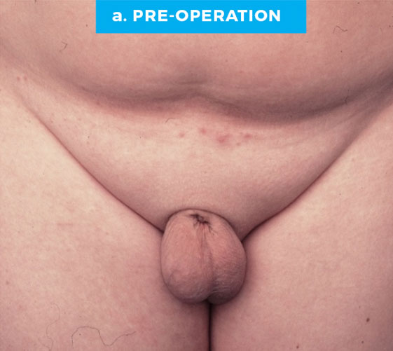 BURIED/HIDDEN PENIS CORRECTIVE SURGERY Patient 7 Before