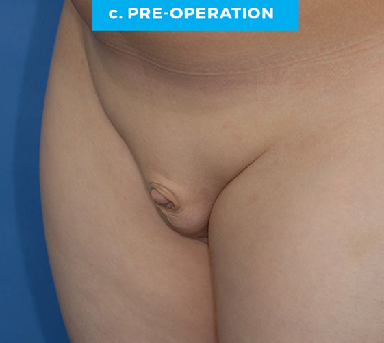 BURIED/HIDDEN PENIS CORRECTIVE SURGERY Patient 8 Before 2
