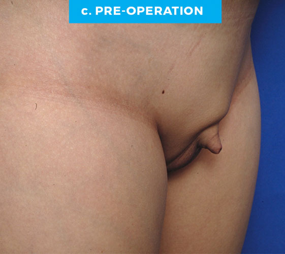 BURIED/HIDDEN PENIS CORRECTIVE SURGERY Patient 9 Before 2