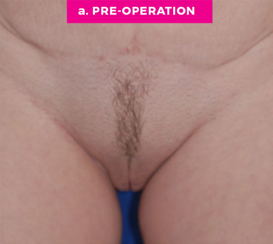 LABIA MAJORA REMODELING Patient 10 Before