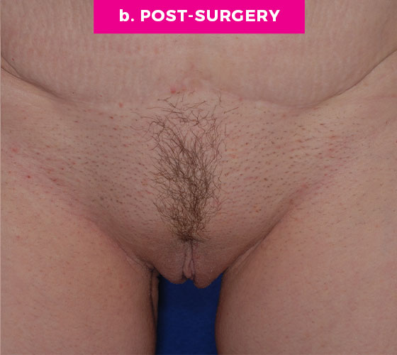 LABIA MAJORA REMODELING Patient 10 After