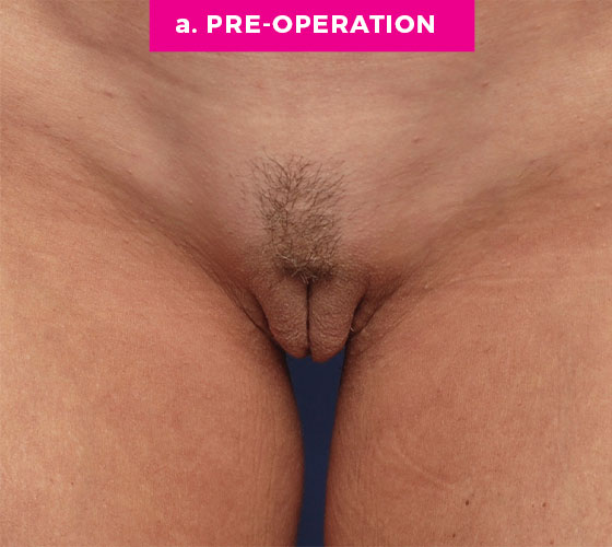 LABIA MAJORA REMODELING Patient 12 Before