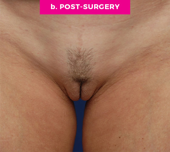 LABIA MAJORA REMODELING Patient 12 After