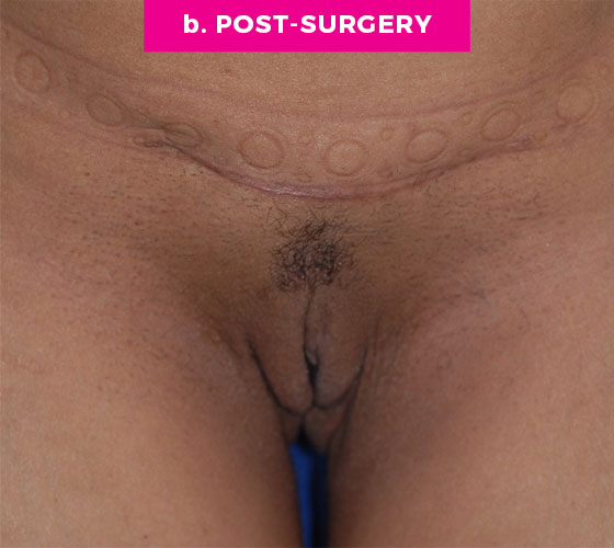 LABIA MAJORA REMODELING Patient 12 After