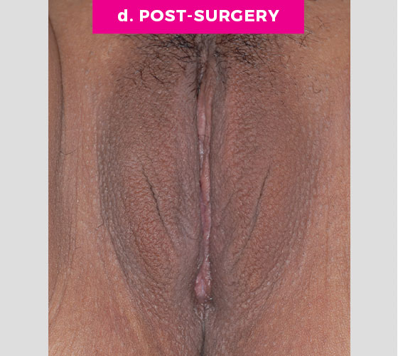 LABIA MAJORA REMODELING Patient 12 After 2