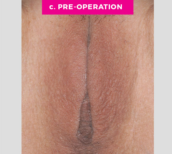 LABIA MAJORA REMODELING Patient 13 Before 2