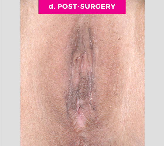 LABIA MAJORA REMODELING Patient 13 After 2