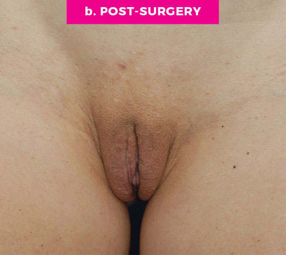 LABIA MAJORA REMODELING Patient 15 After