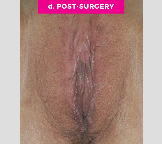 LABIA MAJORA REMODELING Patient 15 After 2