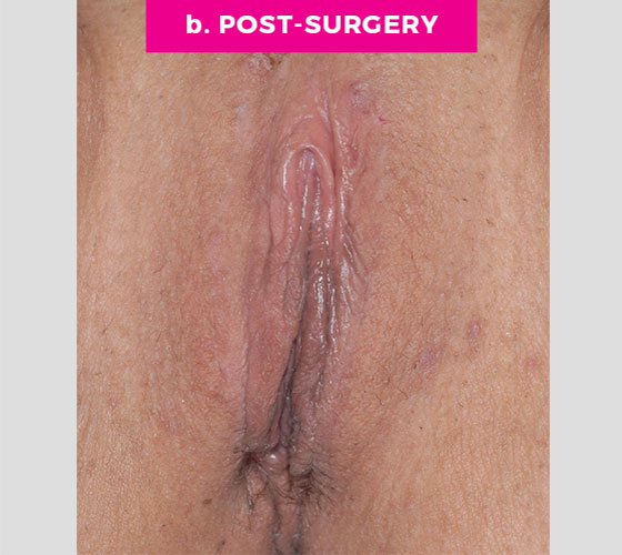 LABIA MAJORA REMODELING Patient 15 After 2