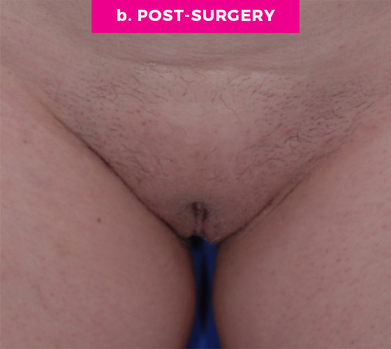 LABIA MAJORA REMODELING Patient 17 After
