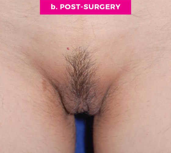 LABIA MAJORA REMODELING Patient 18 After