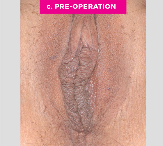 LABIA MAJORA REMODELING Patient 18 Before 2