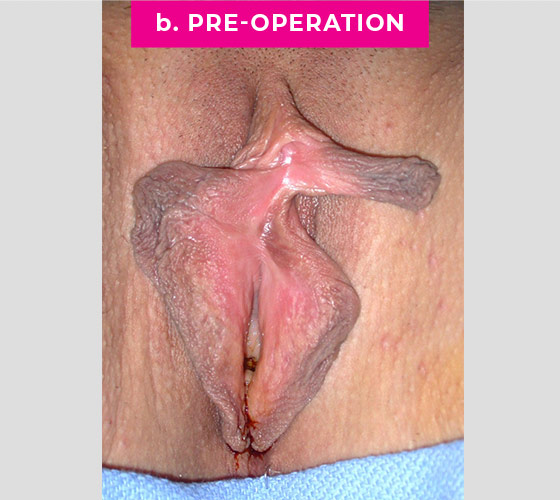 REVISION OF BOTCHED LABIAPLASTIES Patient 30 Before 2