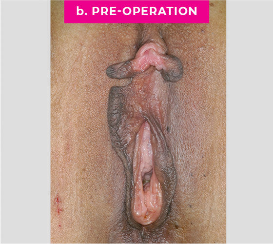 REVISION OF BOTCHED LABIAPLASTIES Patient 34 Before 2