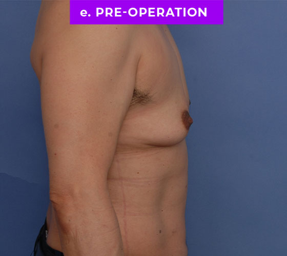 FEMALE-TO-MALE CHEST CONTOURING Patient 24 Before 3