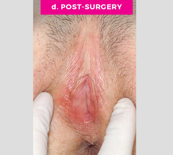 LABIAPLASTY Patient 22 After 2