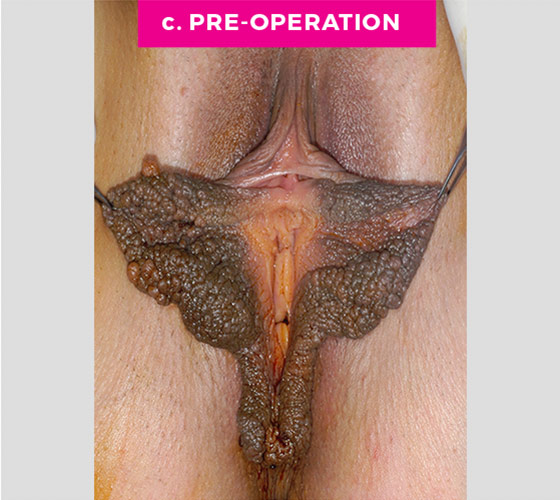 LABIAPLASTY Patient 24 Before 2