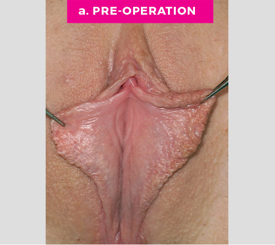 LABIAPLASTY Patient 17 Before 2