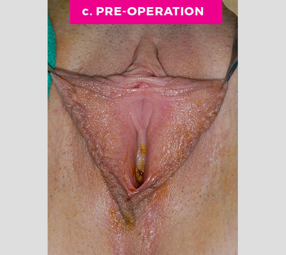 LABIAPLASTY Patient 18 Before 2
