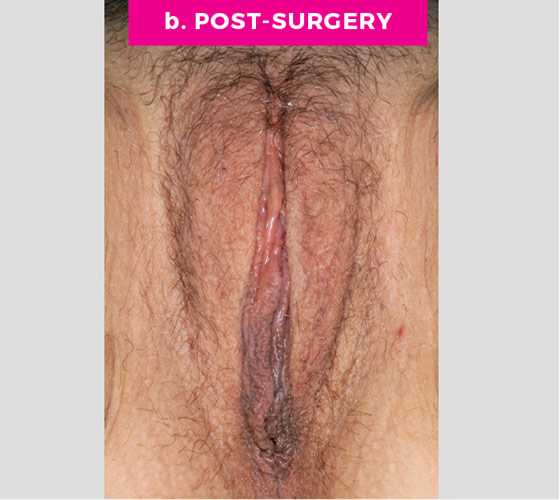LABIAPLASTY Patient 19 After