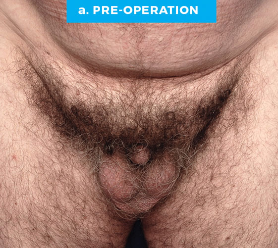 BURIED/HIDDEN PENIS CORRECTIVE SURGERY Patient 12 Before