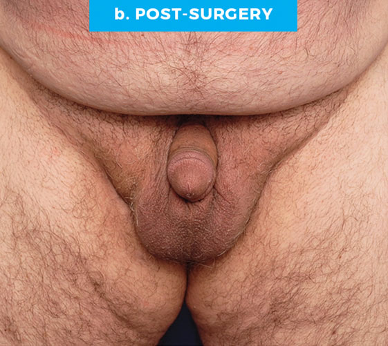 BURIED/HIDDEN PENIS CORRECTIVE SURGERY Patient 12 After
