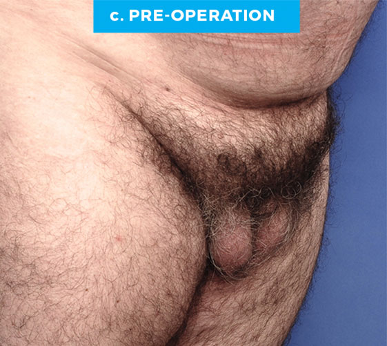 BURIED/HIDDEN PENIS CORRECTIVE SURGERY Patient 12 Before 2