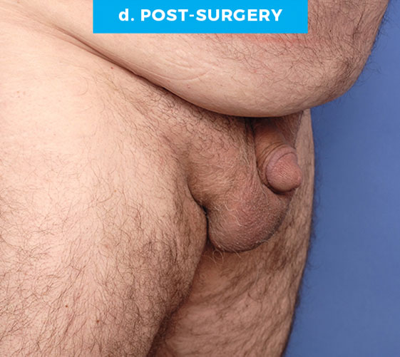 BURIED/HIDDEN PENIS CORRECTIVE SURGERY Patient 12 After 2