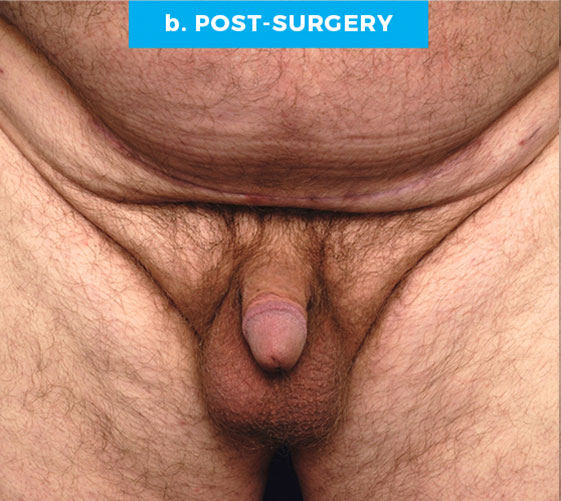 BURIED/HIDDEN PENIS CORRECTIVE SURGERY Patient 14 After