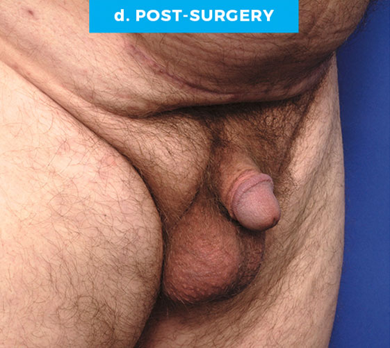 BURIED/HIDDEN PENIS CORRECTIVE SURGERY Patient 14 After 2