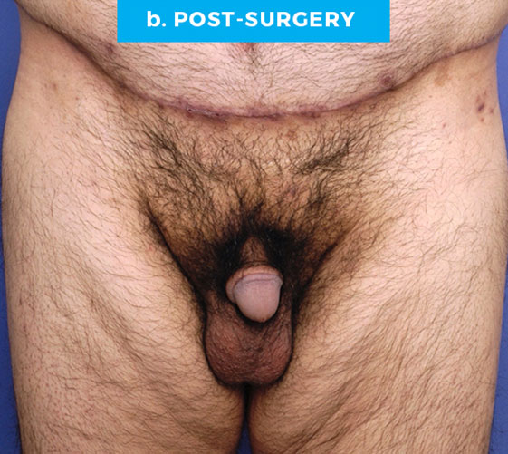 BURIED/HIDDEN PENIS CORRECTIVE SURGERY Patient 15 After