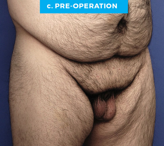 BURIED/HIDDEN PENIS CORRECTIVE SURGERY Patient 15 Before 2
