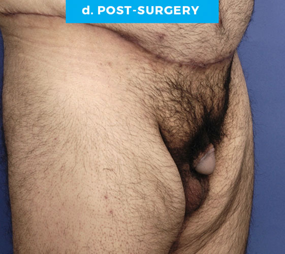 BURIED/HIDDEN PENIS CORRECTIVE SURGERY Patient 15 After 2