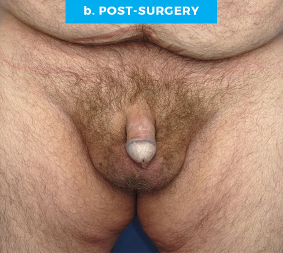 BURIED/HIDDEN PENIS CORRECTIVE SURGERY Patient 16 After
