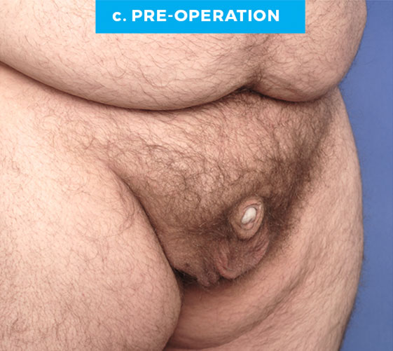 BURIED/HIDDEN PENIS CORRECTIVE SURGERY Patient 16 Before 2