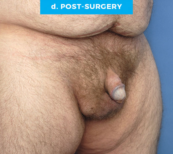 BURIED/HIDDEN PENIS CORRECTIVE SURGERY Patient 16 After 2