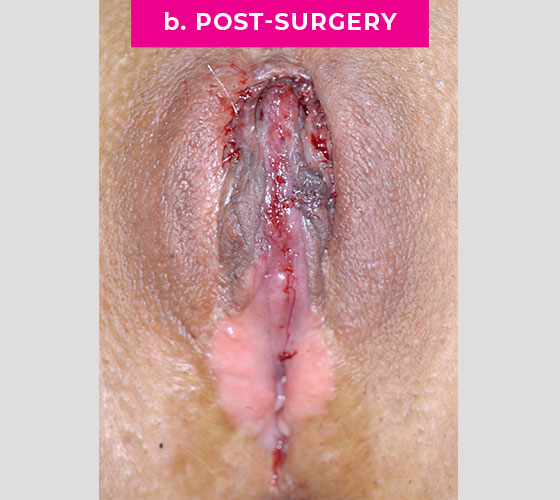 INTERSEX & COMPLEX FEMALE RECONSTRUCTION Patient 2 After