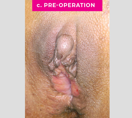 INTERSEX & COMPLEX FEMALE RECONSTRUCTION Patient 2 Before 2