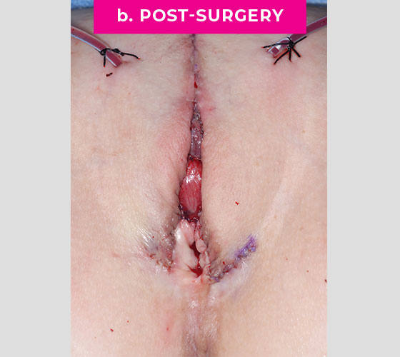 INTERSEX & COMPLEX FEMALE RECONSTRUCTION Patient 3 After