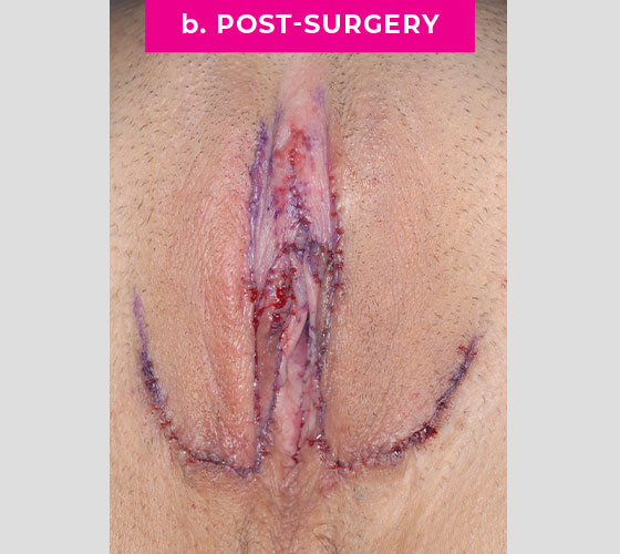 INTERSEX & COMPLEX FEMALE RECONSTRUCTION Patient 4 After
