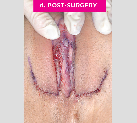 INTERSEX & COMPLEX FEMALE RECONSTRUCTION Patient 4 After 2