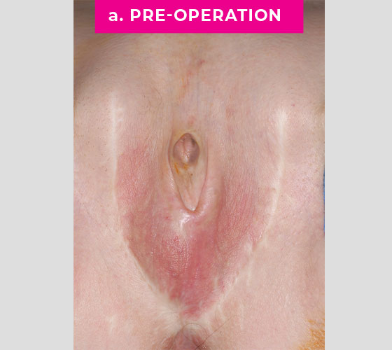 INTERSEX & COMPLEX FEMALE RECONSTRUCTION Patient 5 Before
