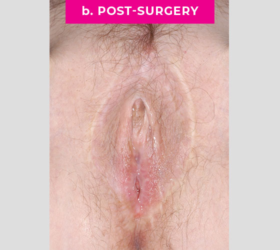 INTERSEX & COMPLEX FEMALE RECONSTRUCTION Patient 5 After
