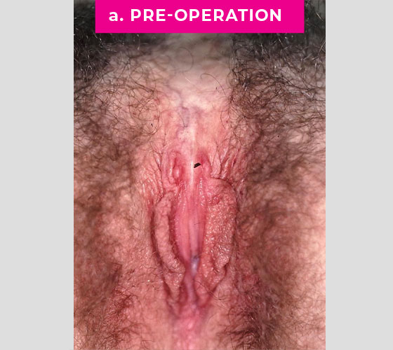 INTERSEX & COMPLEX FEMALE RECONSTRUCTION Patient 7 Before